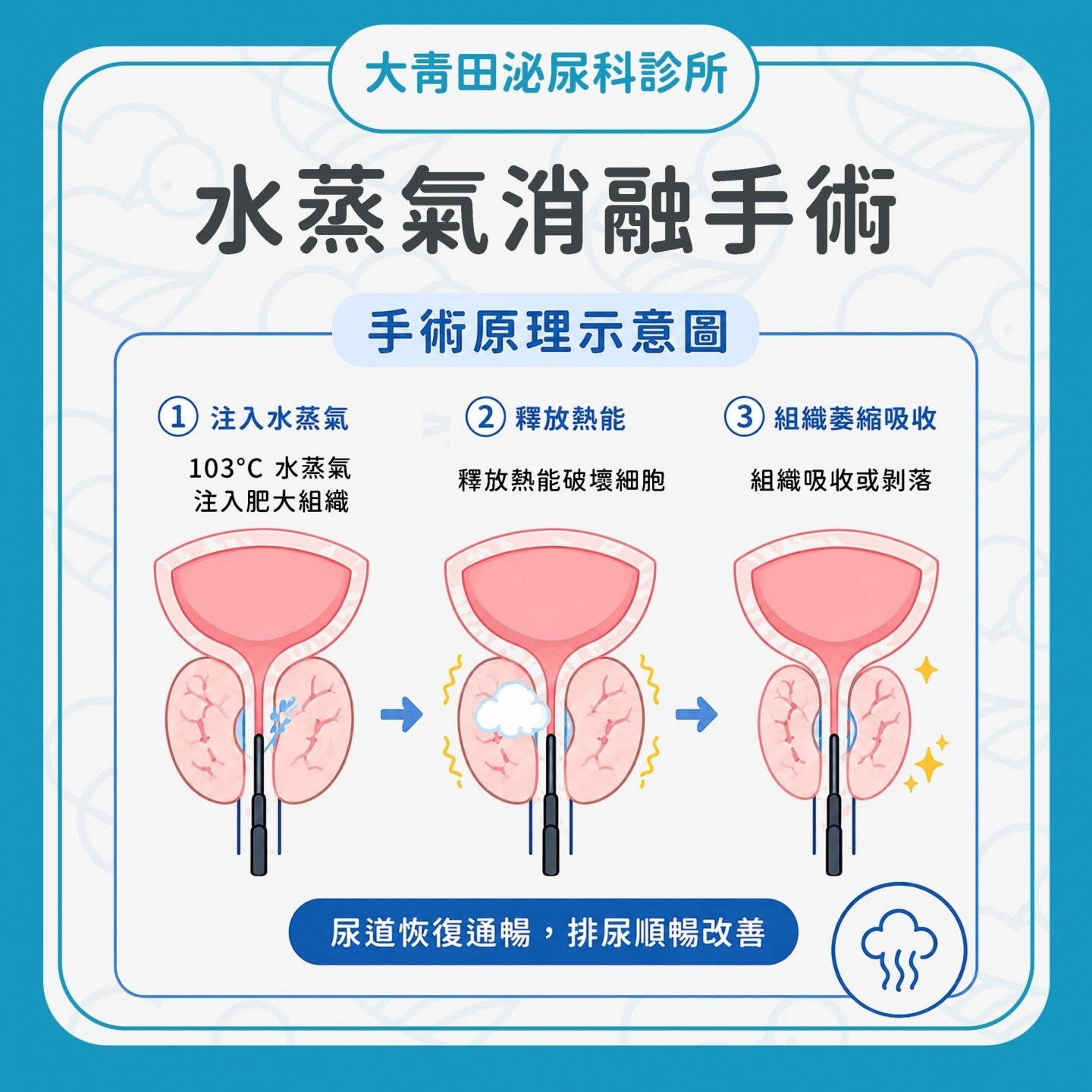 微創攝護腺消融術
